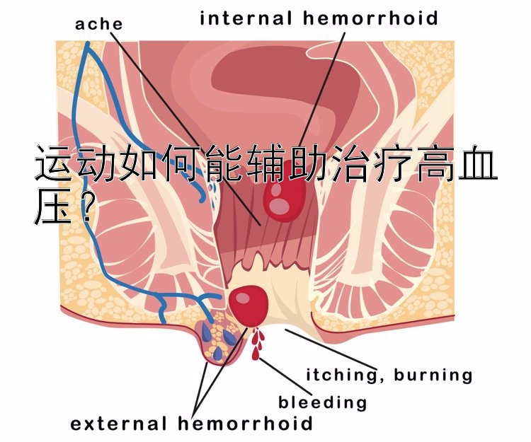 运动如何能辅助治疗高血压？