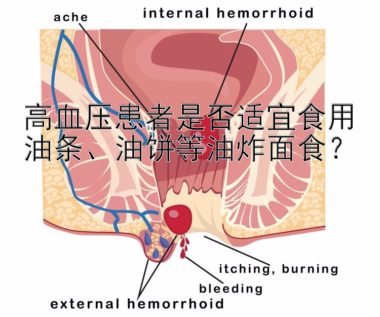 高血压患者是否适宜食用油条、油饼等油炸面食？