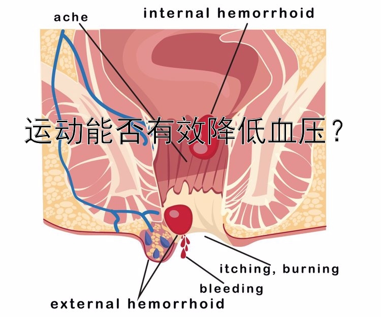 运动能否有效降低血压？